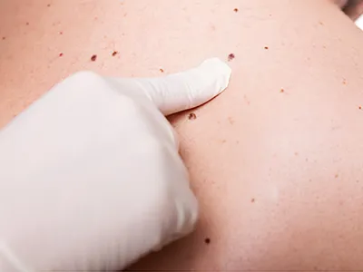 "Cáncer de piel", por Esteban Avello Dermatólogo Centro de Consultas Clínica Puerto Varas